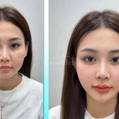 “Gò má cao, má hõm khiến bạn trông già hơn tuổi? – Tiêm má Baby trả lại gương mặt tươi trẻ, phúc hậu