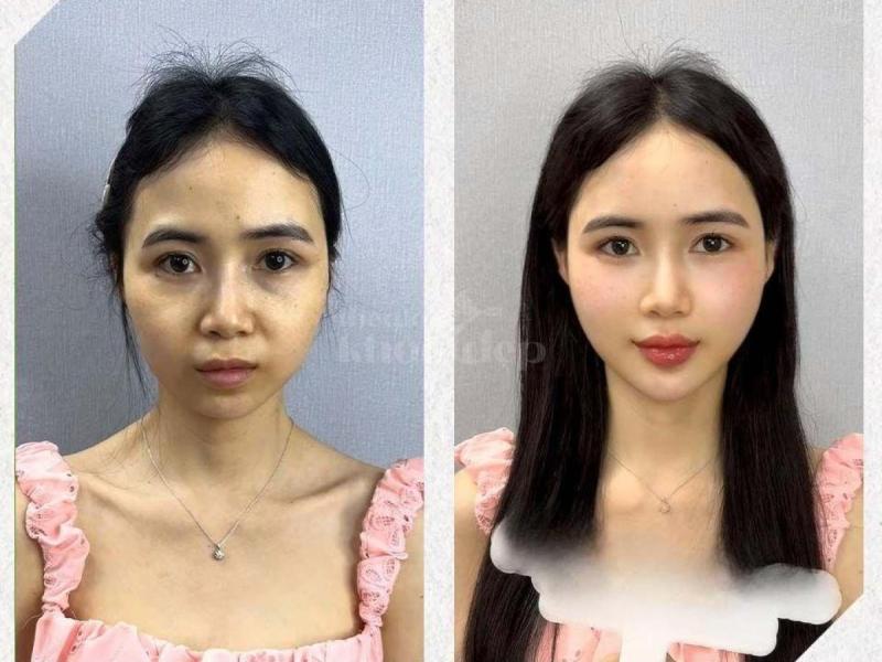 “Trẻ trung, phúc hậu chỉ sau 30 phút – Tiêm má Baby đang là bí quyết trẻ lâu mà phụ nữ hiện đại khôn - 1/4