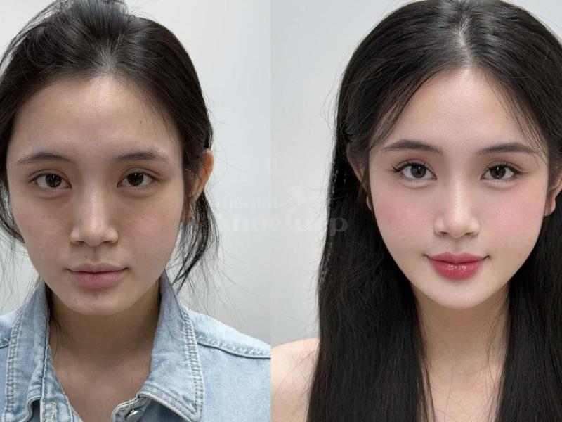 Tiêm má Baby – Lấy lại gương mặt đầy đặn, tươi trẻ cho phụ nữ văn phòng sau stress, mất ngủ kéo dài. - 4/4