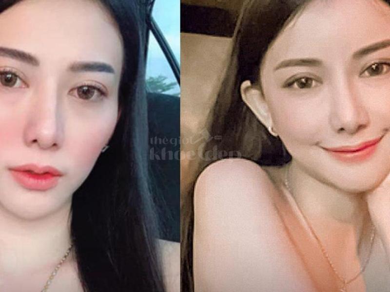 Nam giới trung niên gương mặt hóp, già nua – Tiêm má Baby giúp trẻ trung, tự tin trong công việc và - 1/4