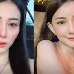 Nam giới trung niên gương mặt hóp, già nua – Tiêm má Baby giúp trẻ trung, tự tin trong công việc và