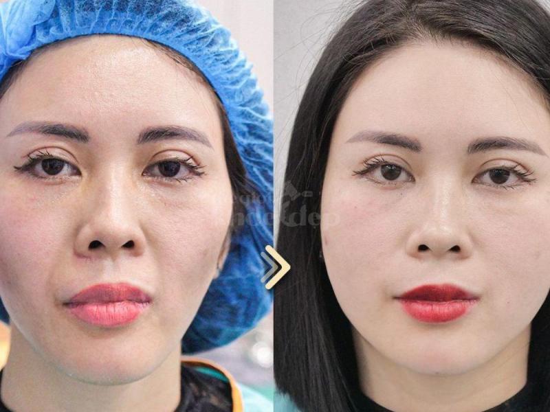 Nam giới trung niên gương mặt hóp, già nua – Tiêm má Baby giúp trẻ trung, tự tin trong công việc và - 2/4