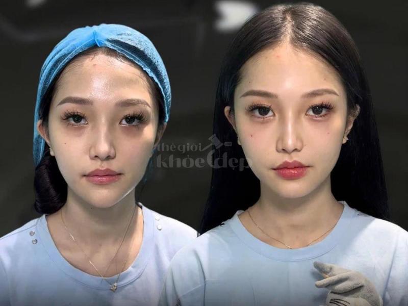 Dân văn phòng ngồi nhiều, stress, da chảy xệ – Tiêm má Baby giúp gương mặt trẻ trung, cân đối chỉ sa - 1/4