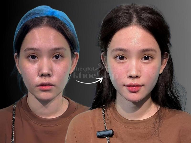 Dân văn phòng ngồi nhiều, stress, da chảy xệ – Tiêm má Baby giúp gương mặt trẻ trung, cân đối chỉ sa - 3/4