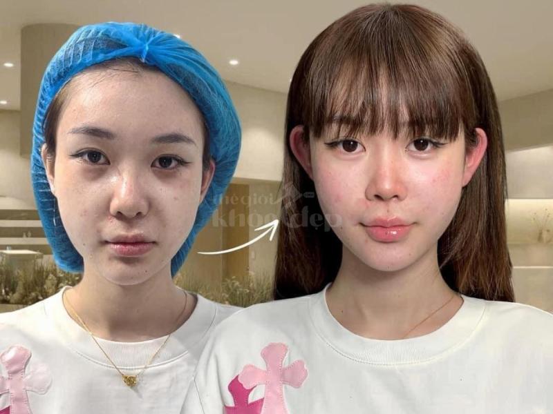 Khách hàng U40–U60 muốn gương mặt đầy đặn, phúc hậu – Tiêm má Baby giúp trẻ ra 5–10 tuổi an toàn, tự - 2/4