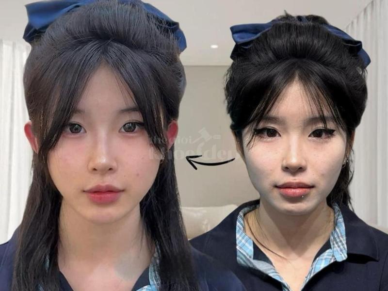 Tiêm má Baby giúp gương mặt V-line nhưng không hóp, vẫn trẻ trung, hài hòa, duyên dáng - 3/4