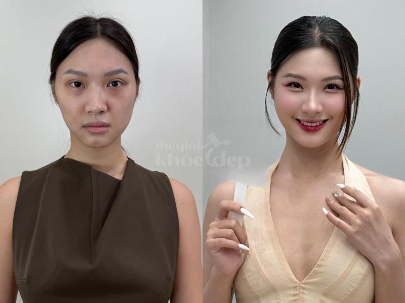 Mẹ bỉm sau sinh má hóp, da chảy xệ – Tiêm má Baby giúp trẻ trung, tự tin trở lại chỉ sau 30 phút. - 2/4