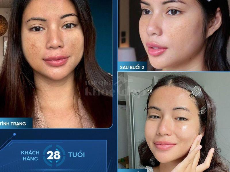 Tiêm Cấy Meso Trẻ Hóa Da – Giải Pháp Khoa Học An Toàn & Hiệu Quả - 1/3