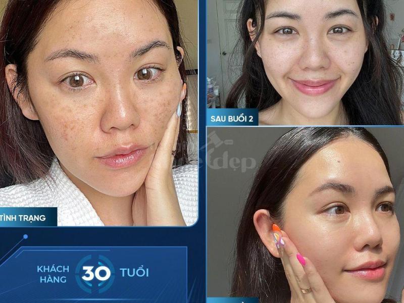Tiêm Cấy Meso Trẻ Hóa Da – Giải Pháp Khoa Học An Toàn & Hiệu Quả - 2/3