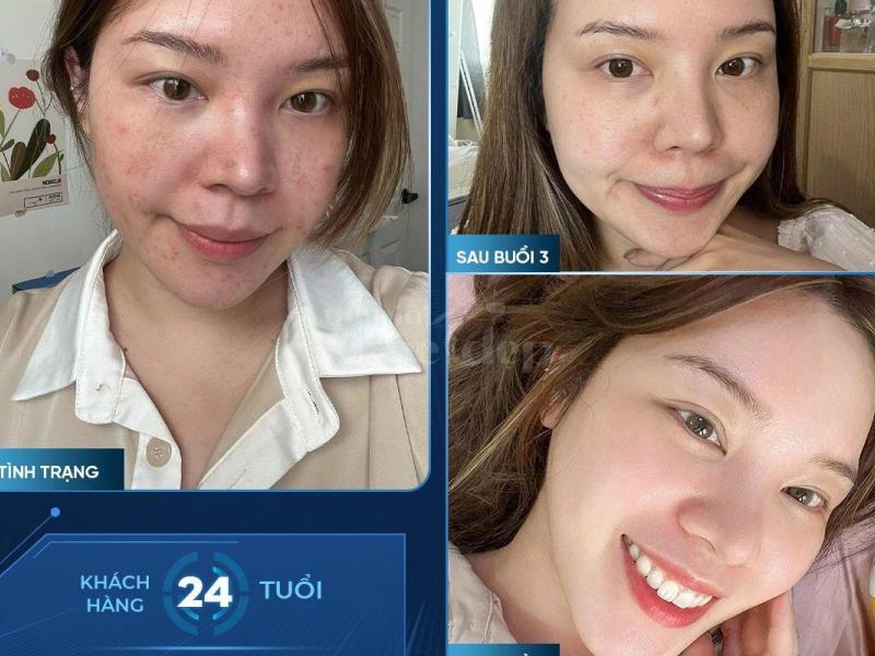 Tiêm Cấy Meso Trẻ Hóa Da – Giải Pháp Khoa Học An Toàn & Hiệu Quả - 3/3