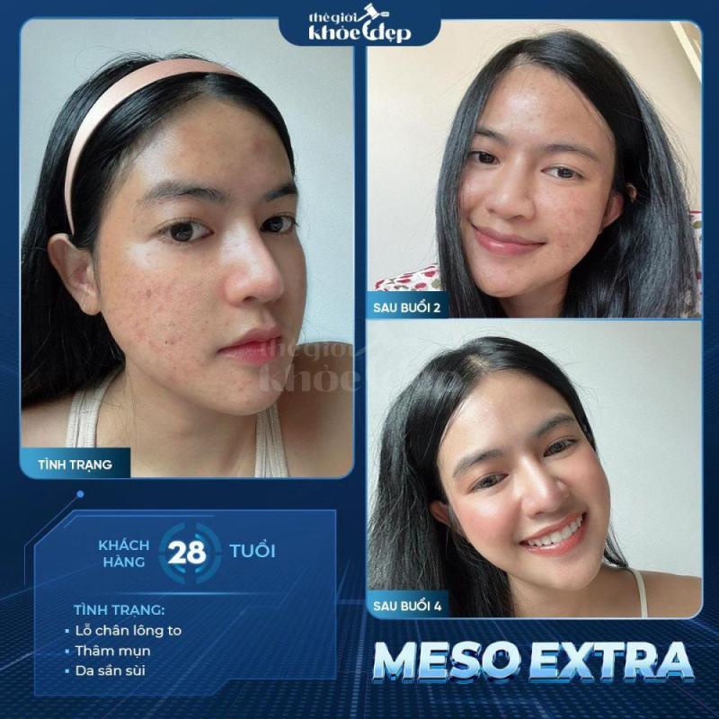Meso Extra Không Kim: Trẻ Hóa Da, Xóa Nhăn Không Xâm Lấn 2025 - 1/3