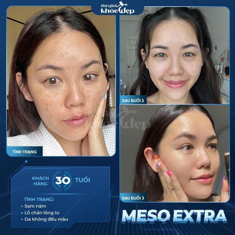 Meso Extra Không Kim: Trẻ Hóa Da, Xóa Nhăn Không Xâm Lấn 2025 - 2/3