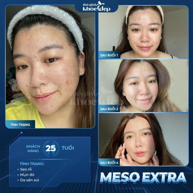Meso Extra Không Kim: Trẻ Hóa Da, Xóa Nhăn Không Xâm Lấn 2025 - 3/3