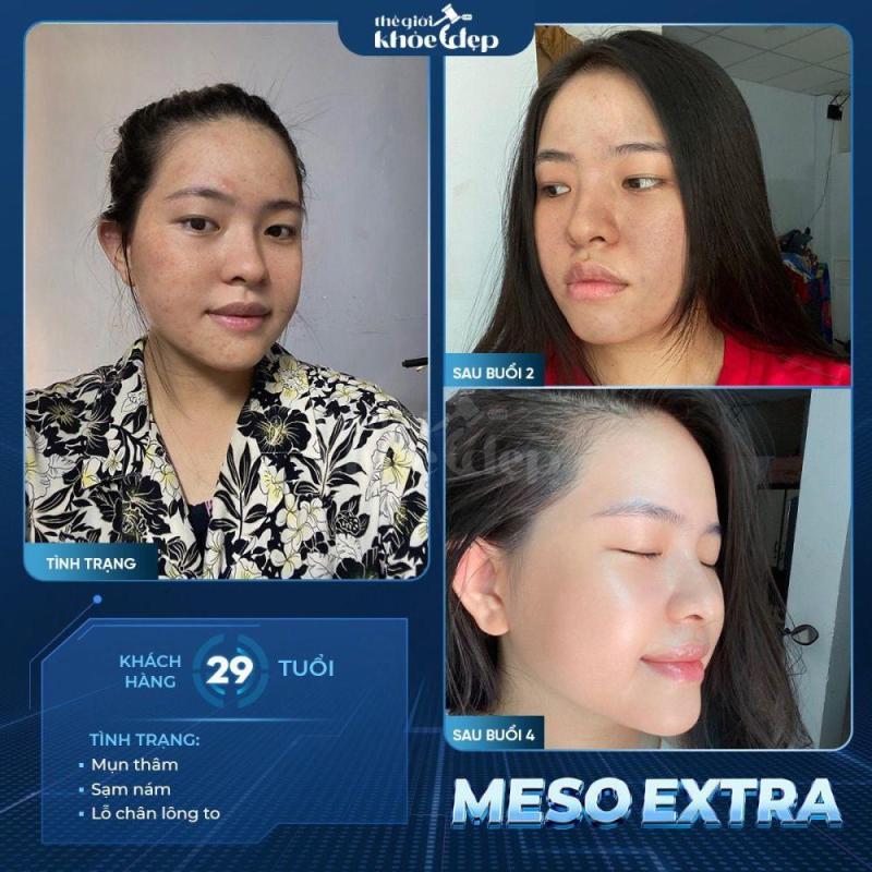 Meso Không Kim Trị Nám Sâu: Phác Đồ Sinh Học An Toàn, Hiệu Quả Lâu Dài - 1/3