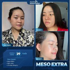 Meso Không Kim Trị Nám Sâu: Phác Đồ Sinh Học An Toàn, Hiệu Quả Lâu Dài