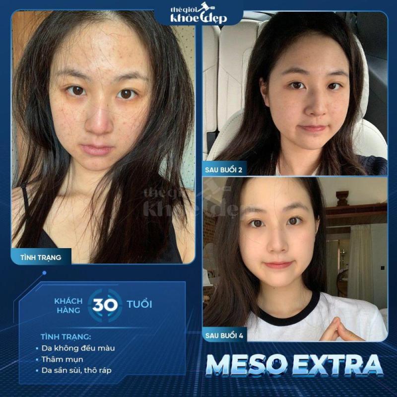 Meso Không Kim Trị Nám Sâu: Phác Đồ Sinh Học An Toàn, Hiệu Quả Lâu Dài - 2/3