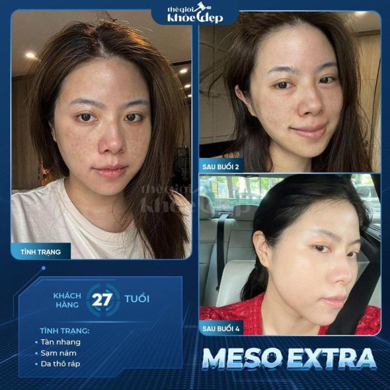 Meso Không Kim Trị Nám Sâu: Phác Đồ Sinh Học An Toàn, Hiệu Quả Lâu Dài - 3/3