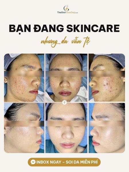 Trị mụn đầu đen - 3/3