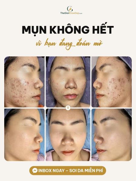 Cải thiện mụn nhanh - 1/3