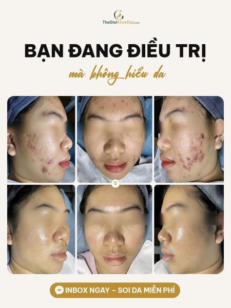 Cải thiện mụn nhanh - 2/3