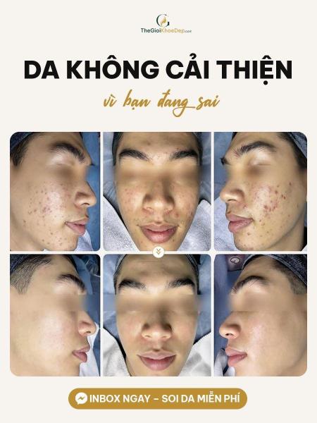 Cải thiện mụn nhanh - 3/3