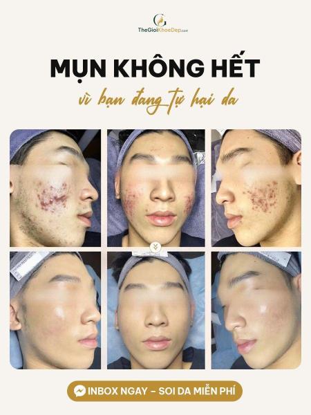 Cải thiện mụn đầu trắng - 1/3