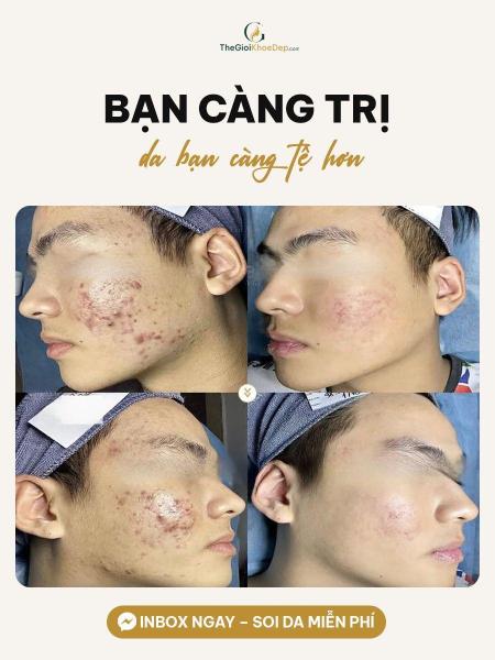 Cải thiện mụn đầu trắng - 2/3