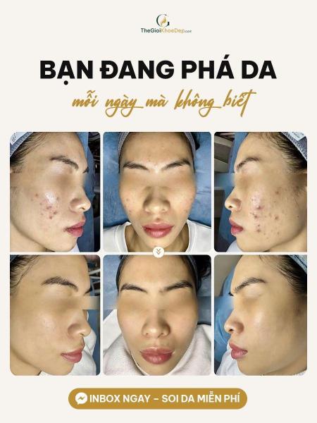 Cải thiện mụn đầu trắng - 3/3