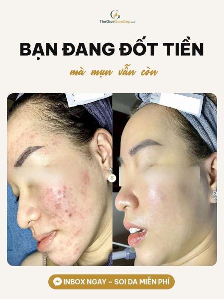 Cải thiện mụn nang - 1/4