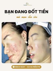 Cải thiện mụn nang