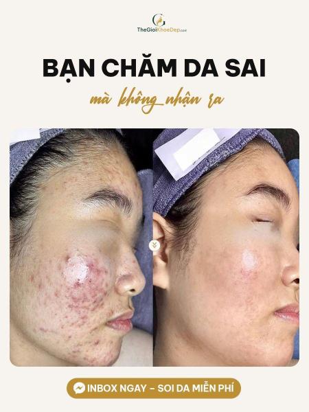 Cải thiện mụn nang - 2/4