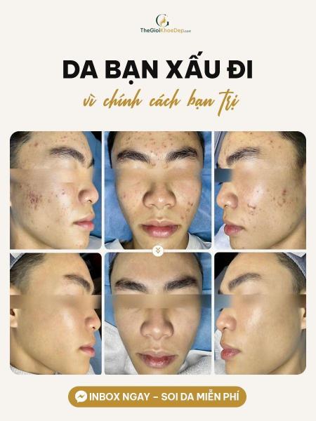 Cải thiện mụn nang - 4/4