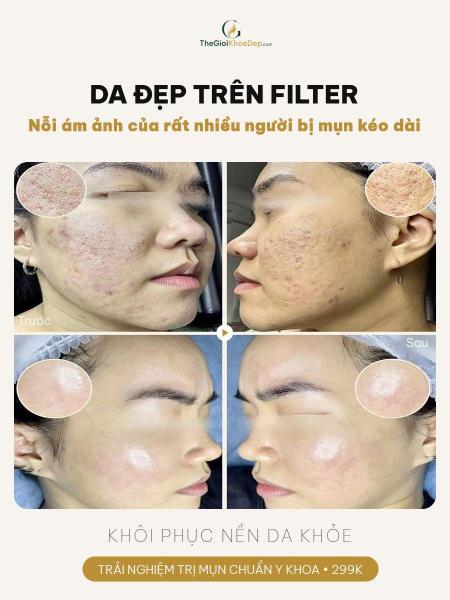Trị sẹo rỗ
