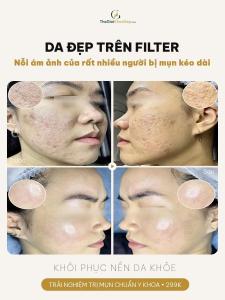 Trị sẹo rỗ