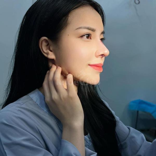 Nâng mũi cấu trúc 4D tự nhiên, an toàn – Giải pháp hoàn hảo cho dáng mũi đẹp lâu dài - 1/6