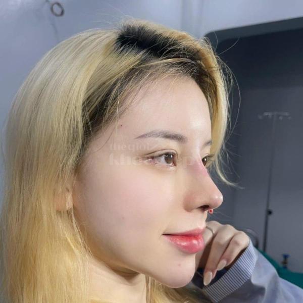 Nâng mũi S-Line 4D – Dáng mũi cao thanh thoát, chuẩn tỷ lệ vàng gương mặt - 1/5