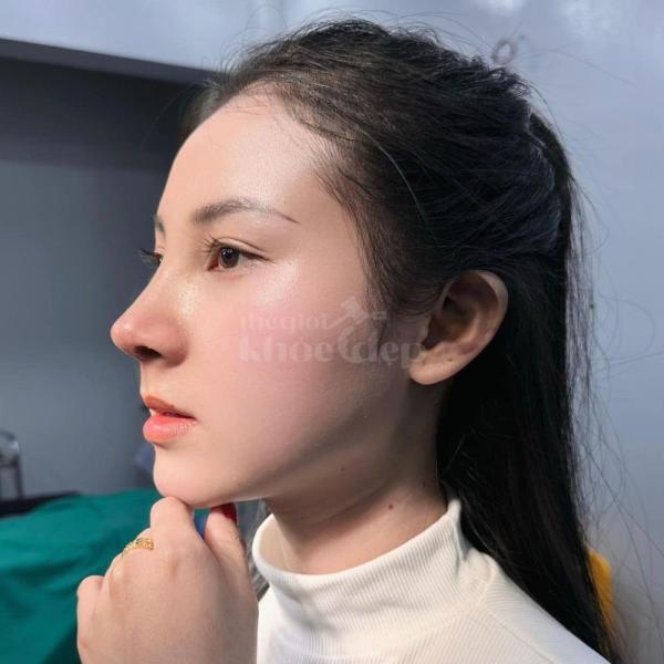 Nâng mũi S-Line 4D – Dáng mũi cao thanh thoát, chuẩn tỷ lệ vàng gương mặt - 4/5