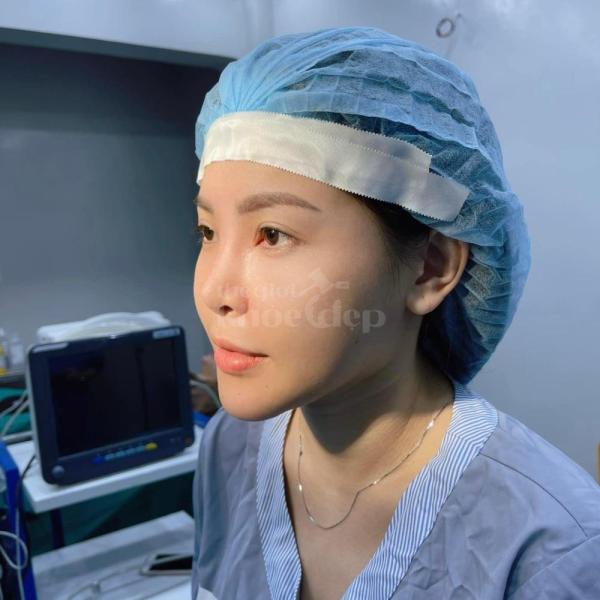 Nâng mũi cấu trúc 6D – Giải pháp tái sinh dáng mũi đẹp chuẩn và bền vững - 1/4