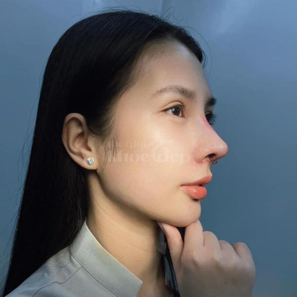 Phẫu thuật nâng mũi đẹp – Giải pháp chuẩn cho gương mặt thanh tú, sang trọng - 1/4