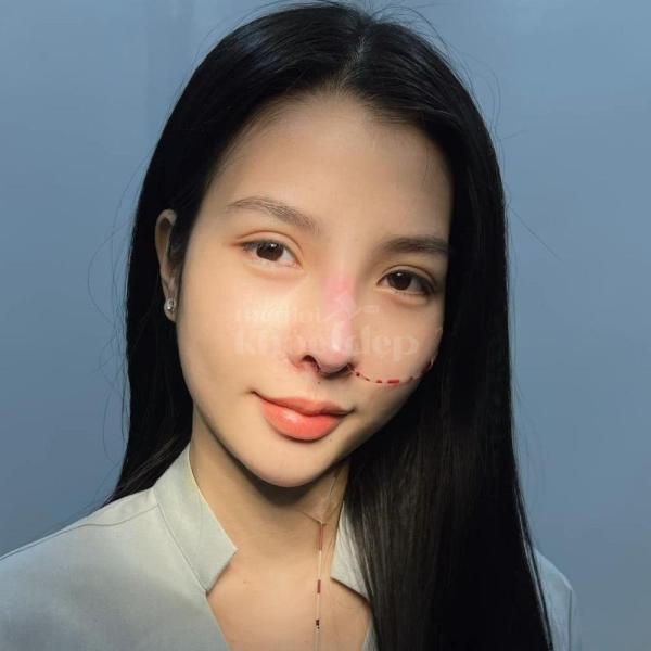 Phẫu thuật nâng mũi đẹp – Giải pháp chuẩn cho gương mặt thanh tú, sang trọng - 3/4