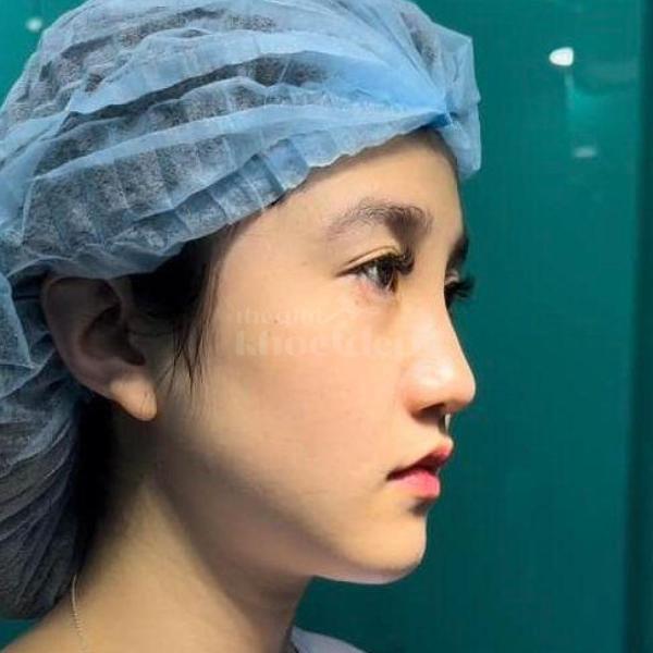 Phẫu thuật nâng mũi đẹp – Giải pháp chuẩn cho gương mặt thanh tú, sang trọng - 4/4