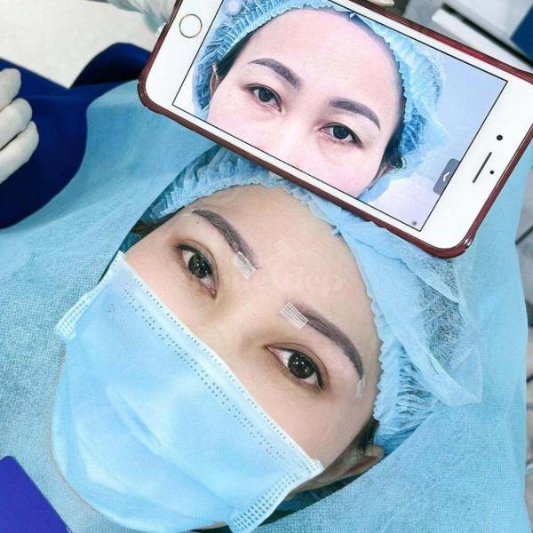 Cắt mắt 2 mí an toàn – trẻ hóa đôi mắt, khắc phục sụp mí, lấy lại vẻ tự tin - 1/3