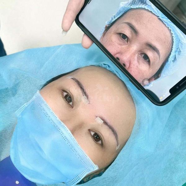 Cắt mắt 2 mí – Nhấn mí Mini Deep an toàn, đẹp tự nhiên, trẻ trung - 1/3