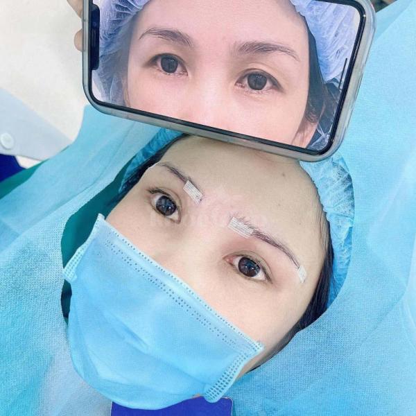 Cắt mắt 2 mí – Nhấn mí Mini Deep an toàn, đẹp tự nhiên, trẻ trung - 2/3