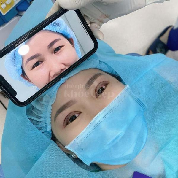 Cắt mắt 2 mí – Nhấn mí Mini Deep an toàn, đẹp tự nhiên, trẻ trung - 3/3