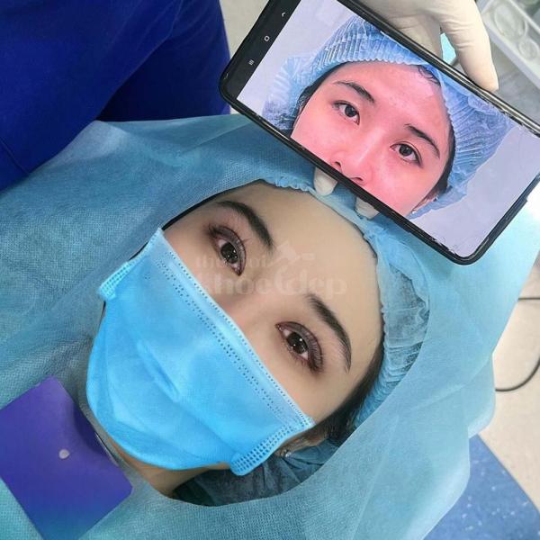 Cắt mắt 2 mí an toàn – trẻ hóa đôi mắt, khắc phục sụp mí, lấy lại vẻ tự tin - 3/3