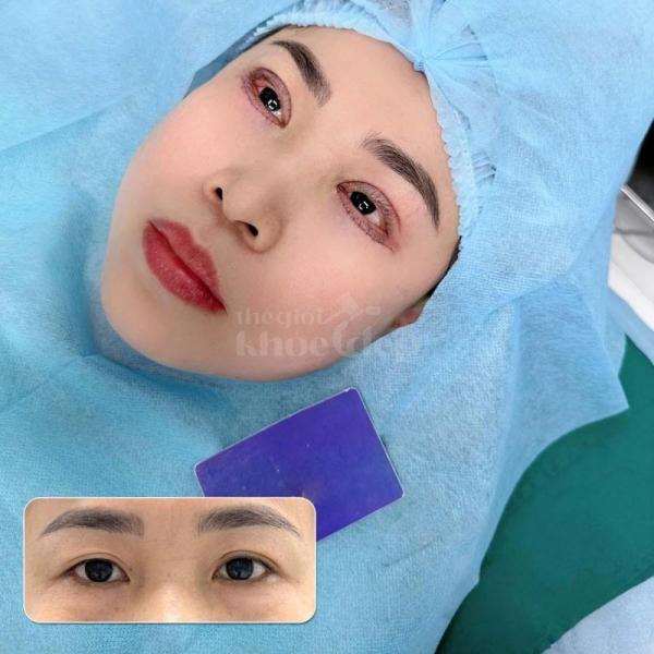 Nhấn mí Mini Deep 2026 – Bí quyết đôi mắt to tròn, trẻ trung tự nhiên - 2/3