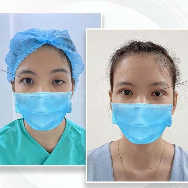 Cắt mí 2 mí & Nhấn mí Mini Deep – Trẻ hóa ánh mắt tự nhiên, an toàn - 1/3