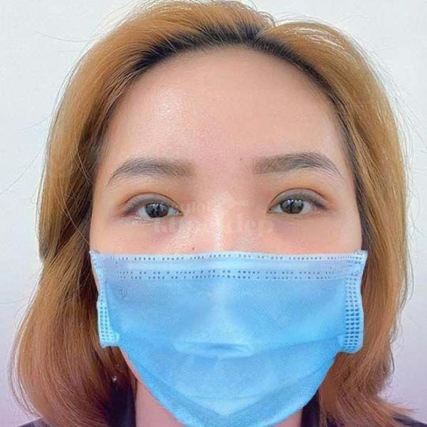 Cắt mí 2 mí & Nhấn mí Mini Deep – Trẻ hóa ánh mắt tự nhiên, an toàn - 2/3