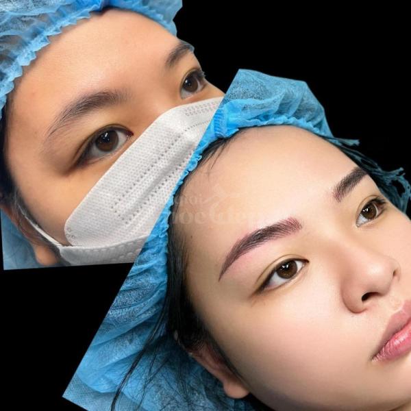 Cắt mí & Nhấn mí Mini Deep – Mắt to rõ mí, khắc phục mí lót hiệu quả - 1/3